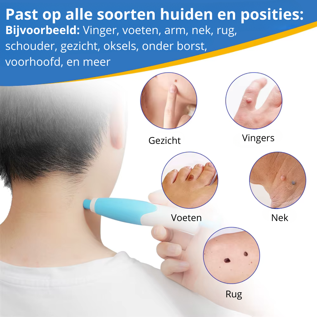 EpiTight™ | Huidflapjes & Wratten Verwijderaar