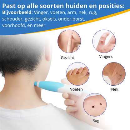 EpiTight™ | Huidflapjes & Wratten Verwijderaar
