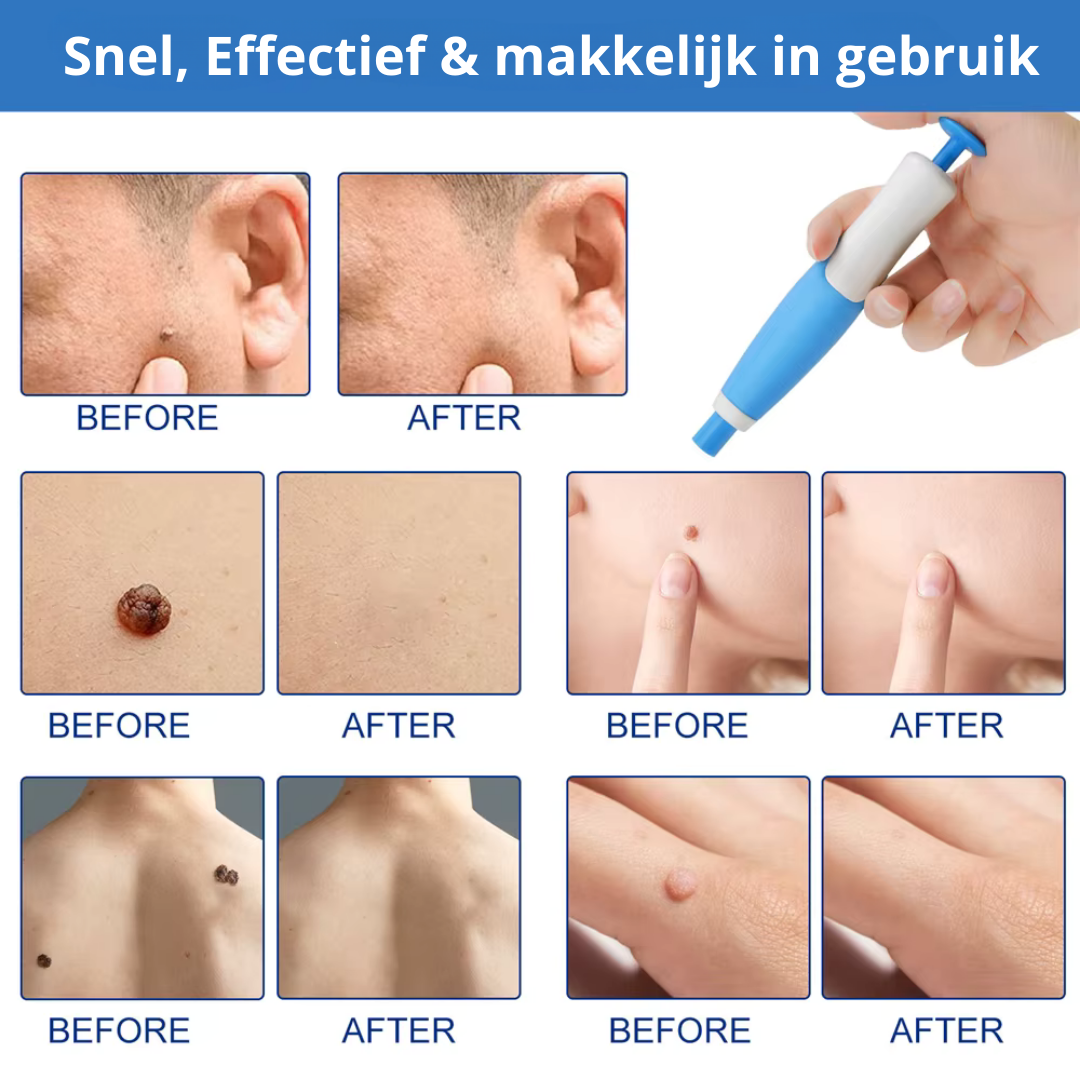 EpiTight™ | Huidflapjes & Wratten Verwijderaar